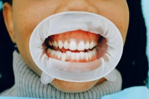 Everything You Need to Know About Gum Disease