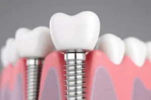 Affordable Dental Implants In Baytown TX