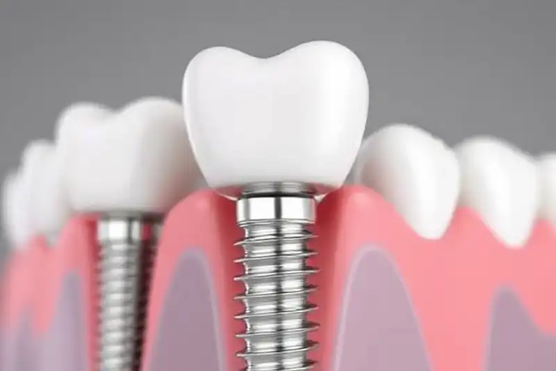 Affordable Dental Implants In Baytown TX